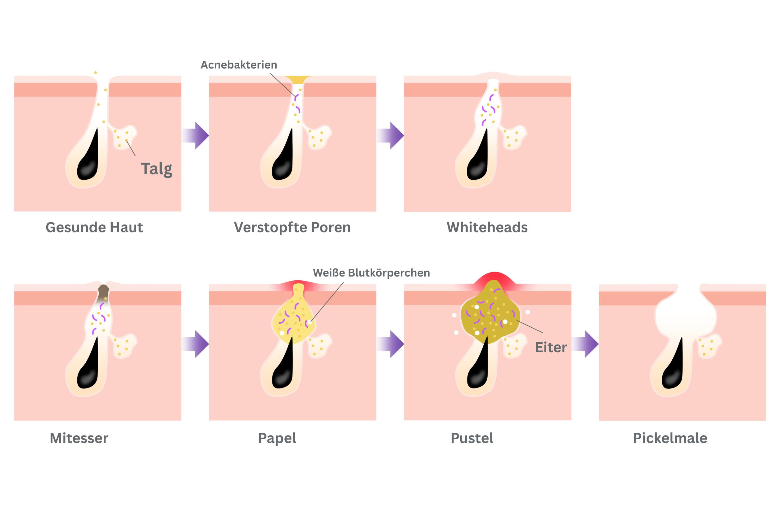 Schematische Darstellung der Entstehung einer Akne von einer gesunden Pore über Whiteheads, Blackheads, Papeln und Pusteln bis hin zu einer Aknenarbe.
